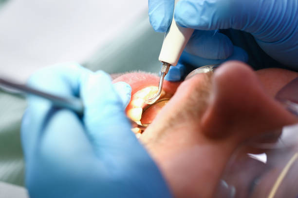 Best Emergency Dentist for Lost Fillings or Crowns in Sissonville, WV