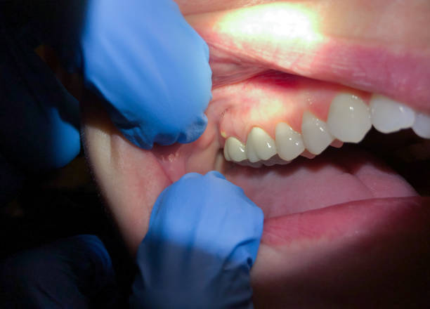 Best Emergency Dental Services for Seniors in Sissonville, WV